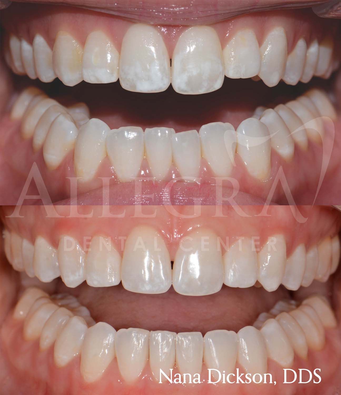 Veneers Before and After case 35 from Allegra Dental Center