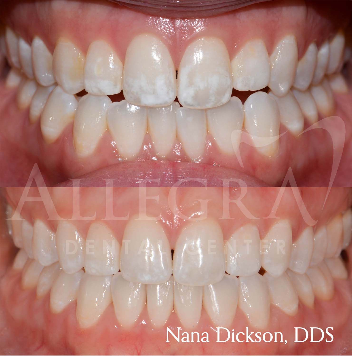 Veneers Before and After case 36 from Allegra Dental Center