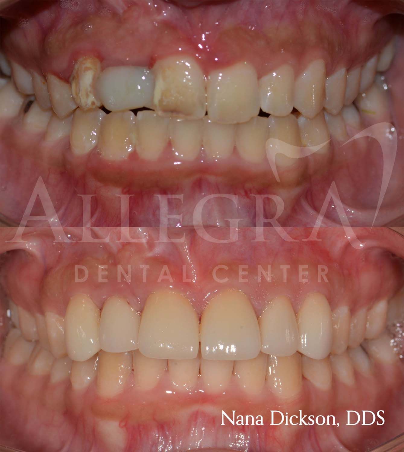 Veneers Before and After case 37 from Allegra Dental Center