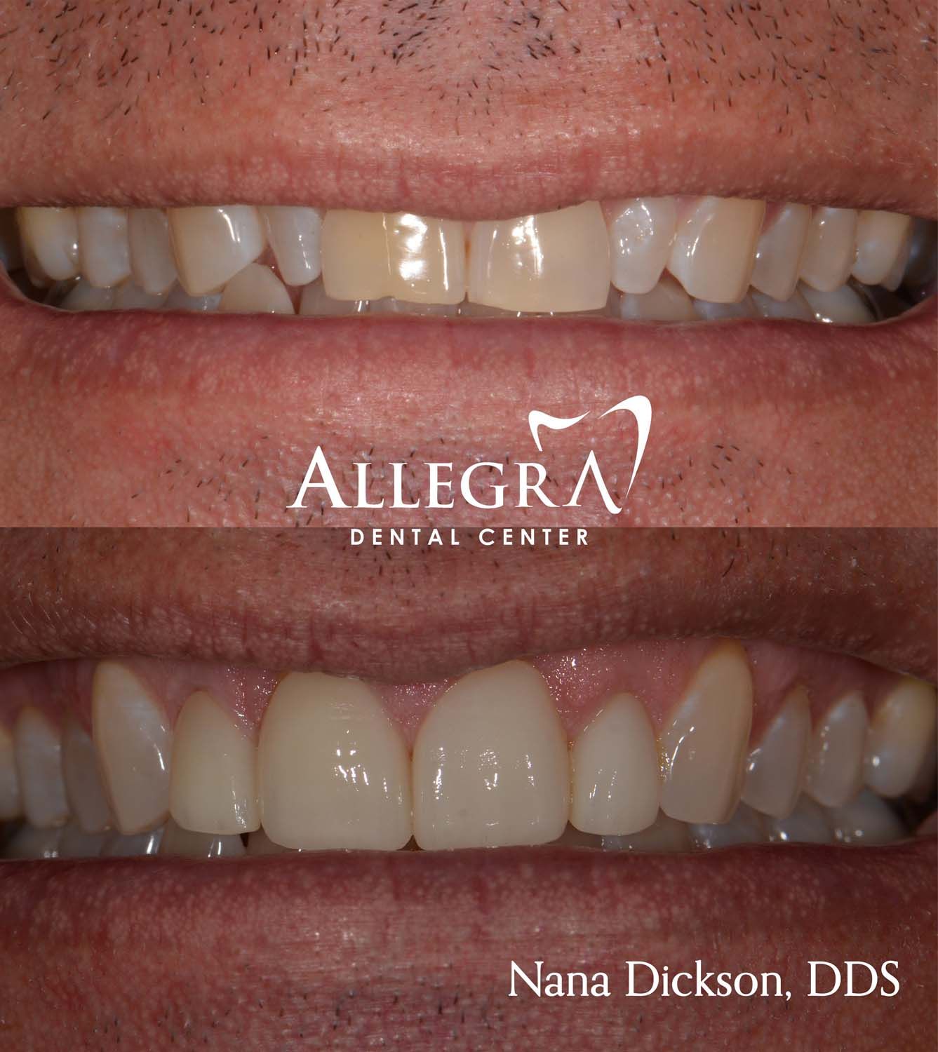 Veneers Before and After case 38 from Allegra Dental Center