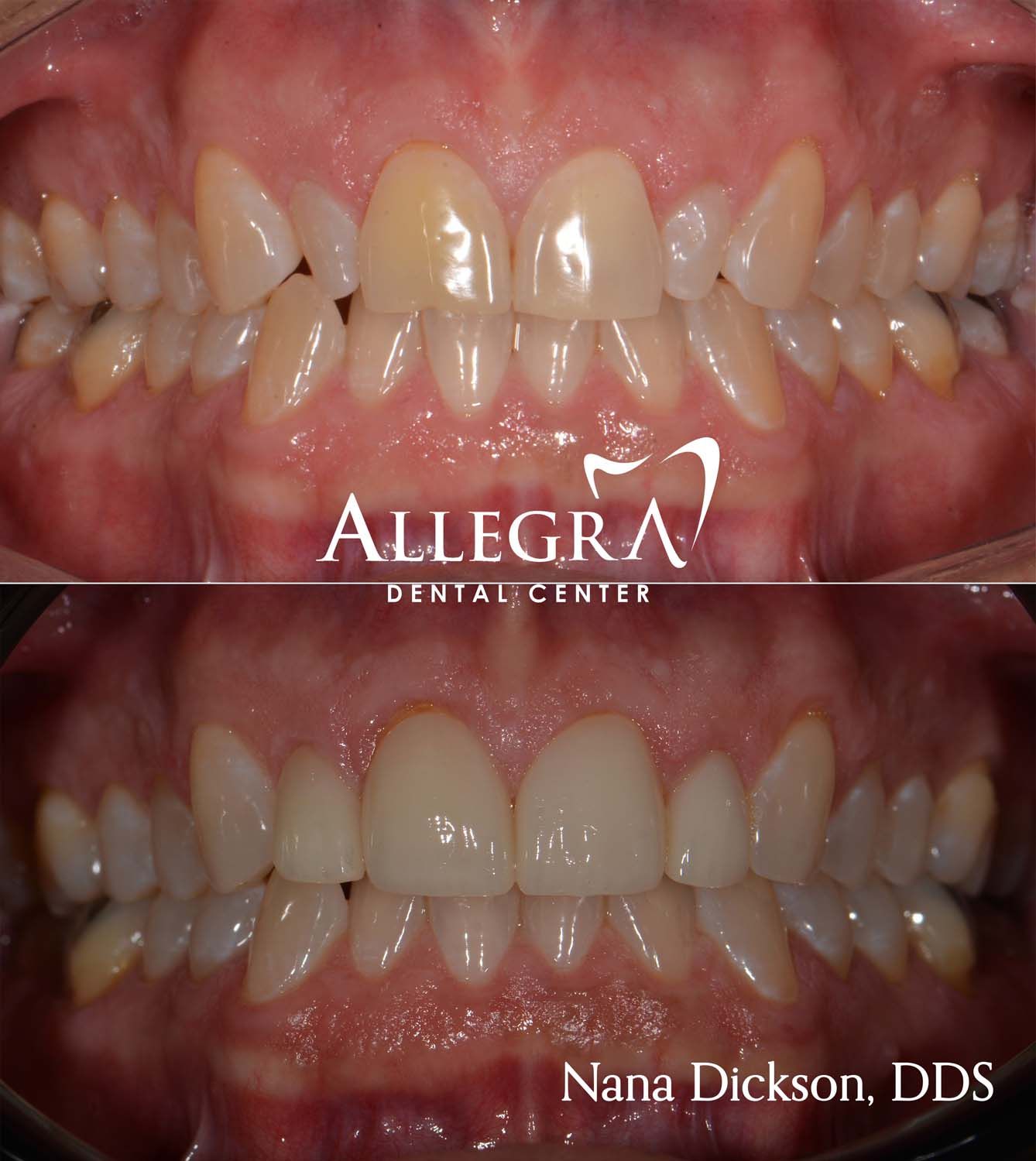 Veneers Before and After case 39 from Allegra Dental Center