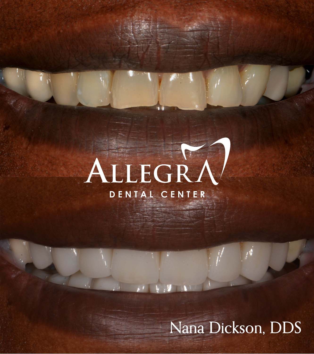 Veneers Before and After case 40 from Allegra Dental Center