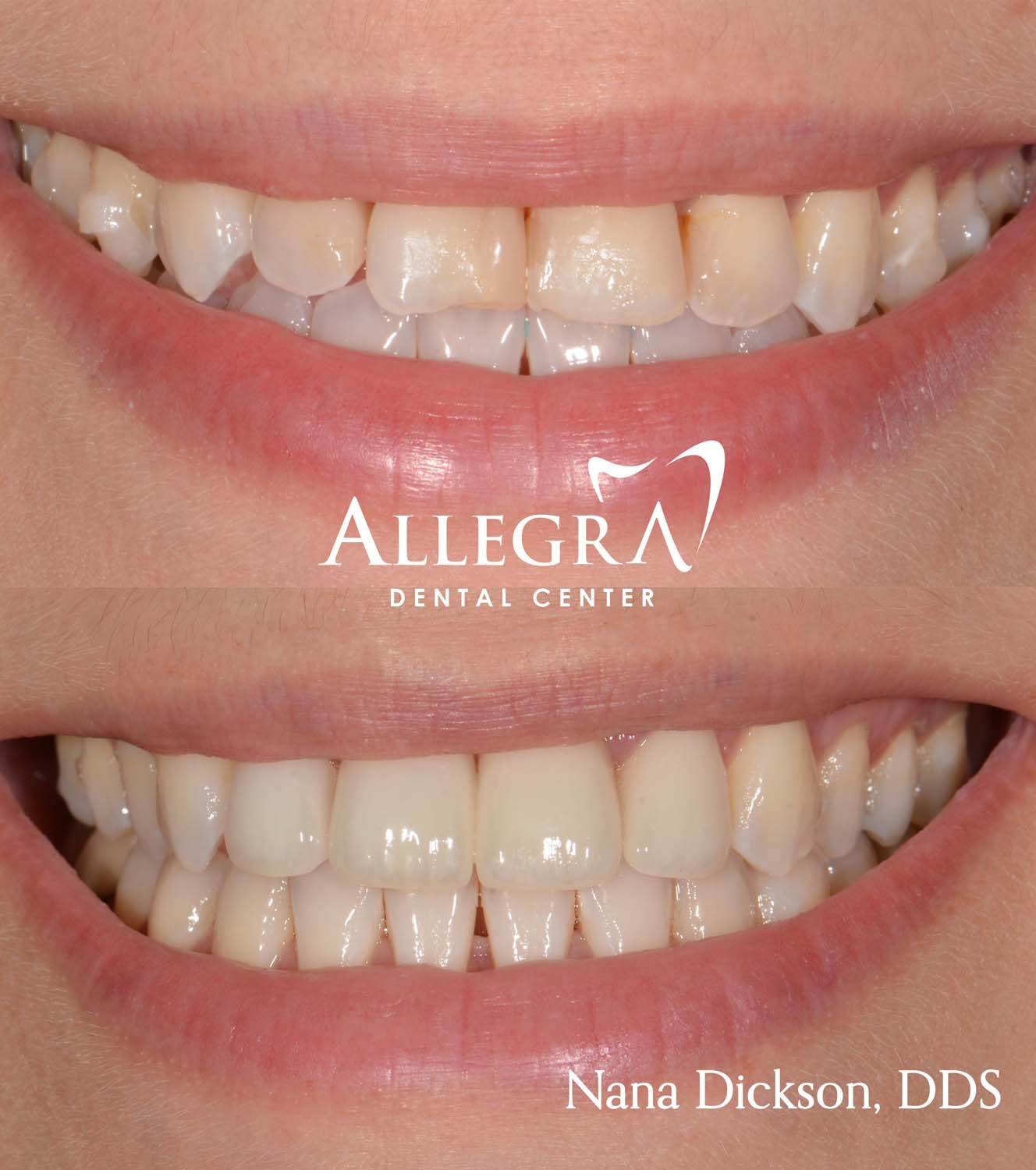 Veneers Before and After case 41 from Allegra Dental Center