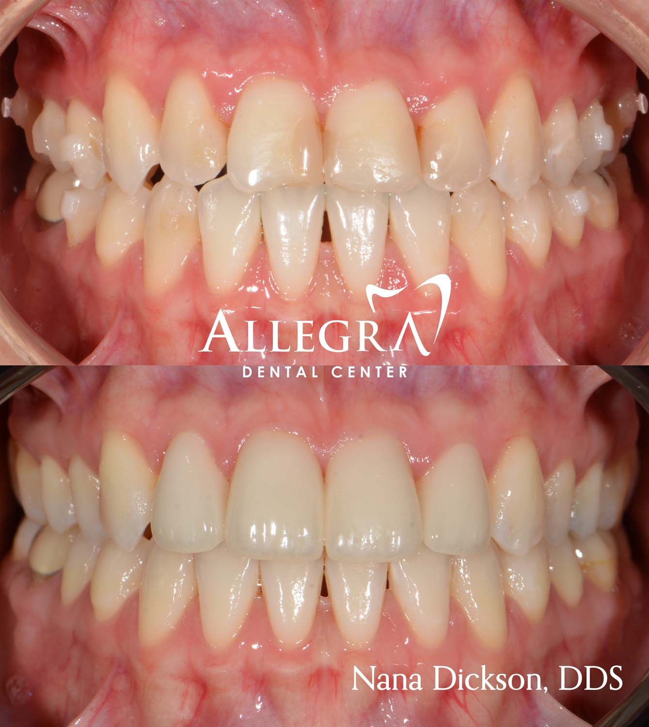Veneers Before and After case 42 from Allegra Dental Center