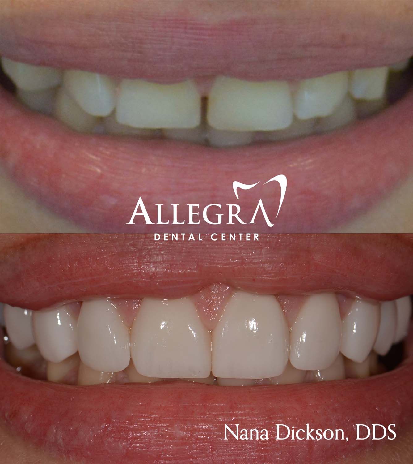 Veneers Before and After case 43 from Allegra Dental Center
