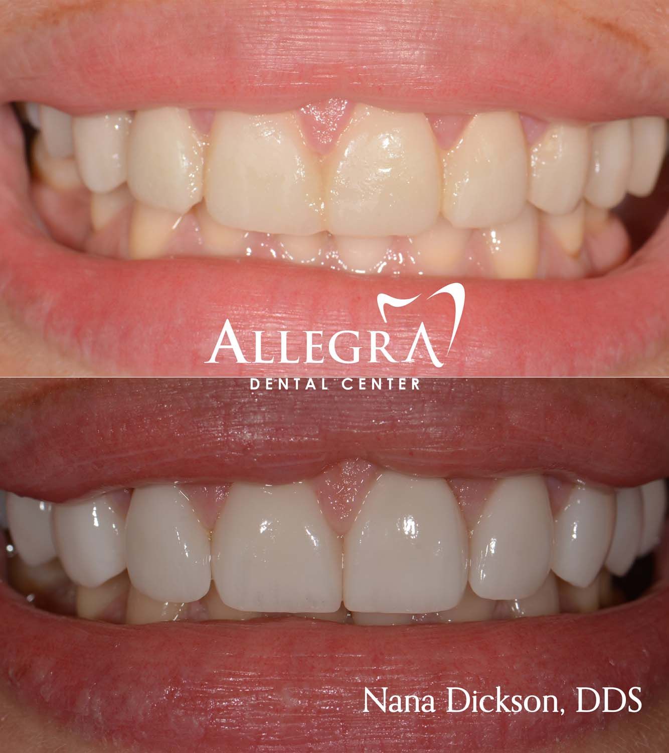 Veneers Before and After case 44 from Allegra Dental Center