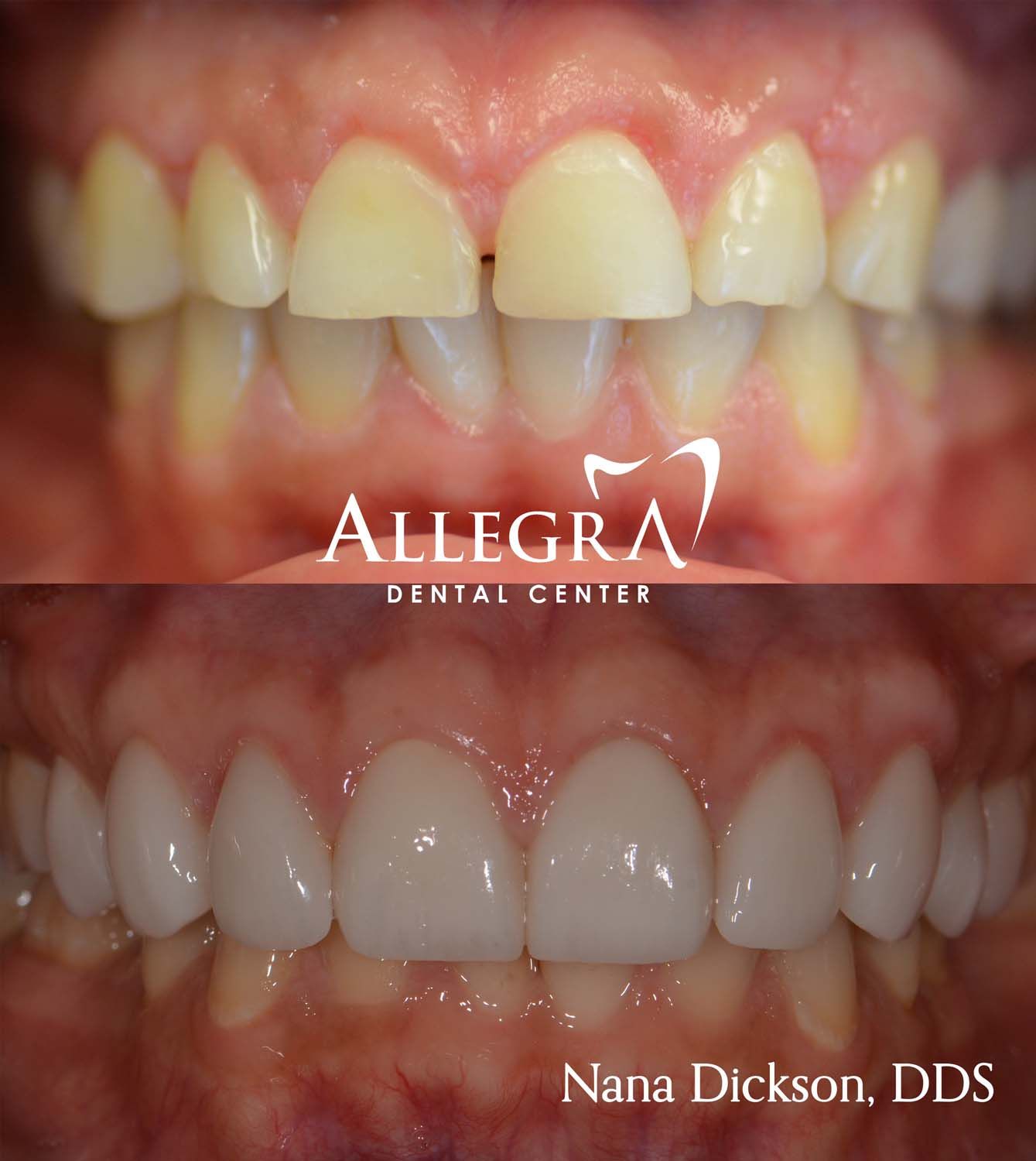 Veneers Before and After case 45 from Allegra Dental Center