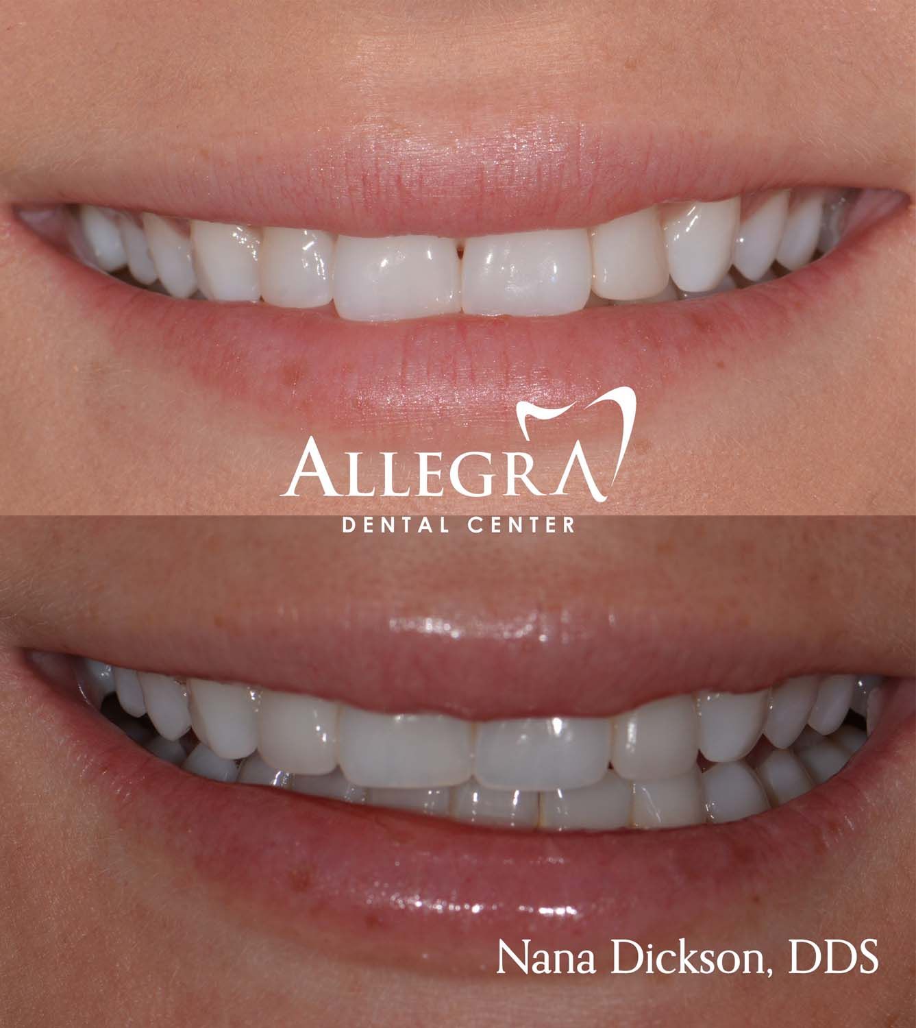 Veneers Before and After case 46 from Allegra Dental Center