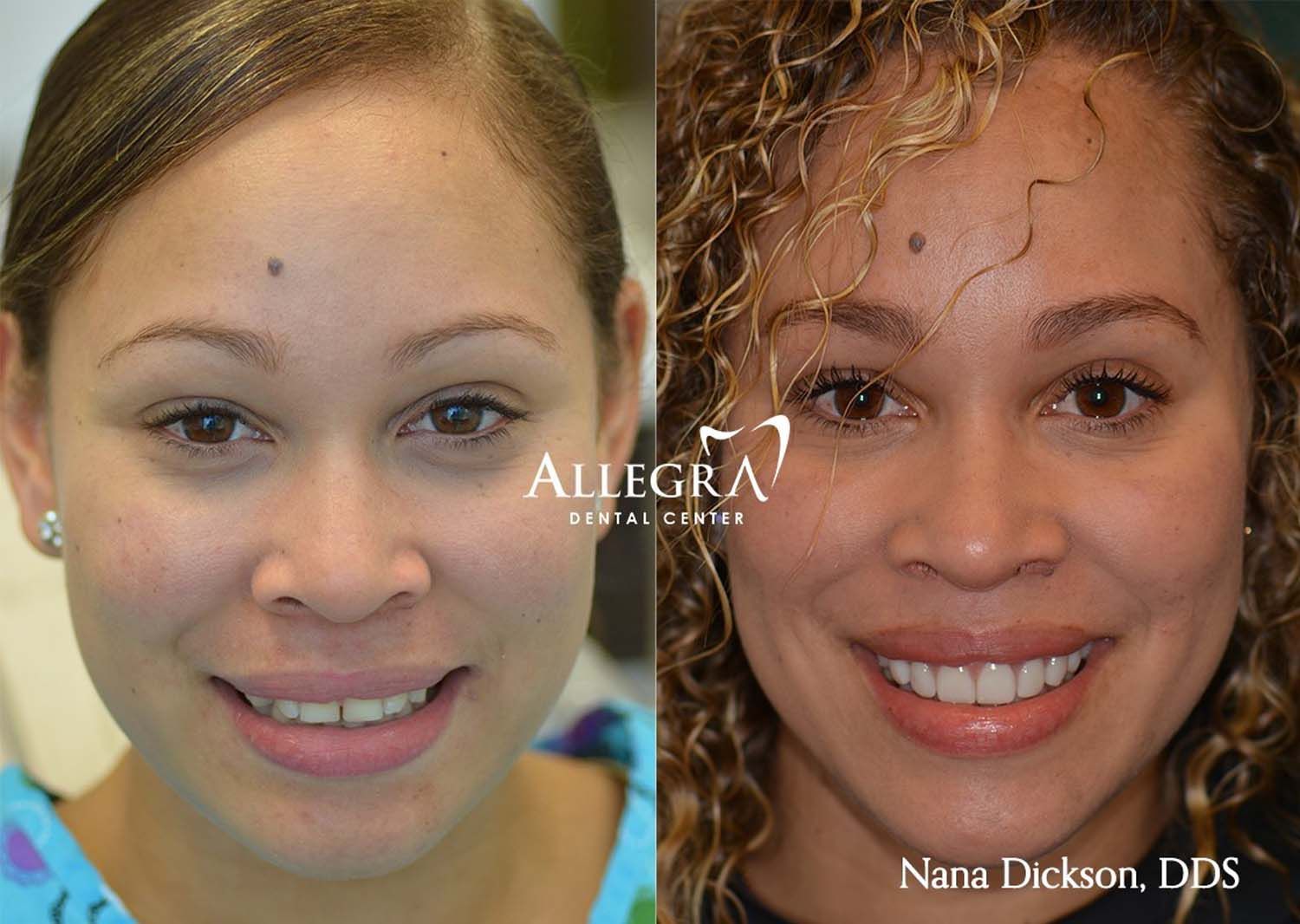 Veneers Before and After case 47 from Allegra Dental Center