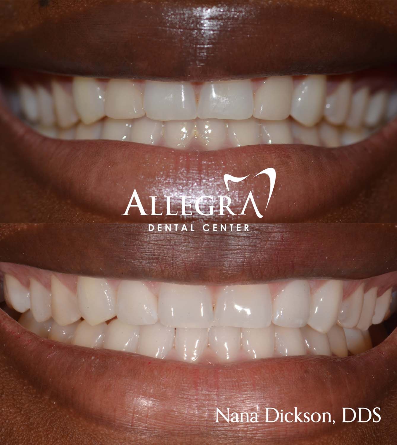 Veneers Before and After case 48 from Allegra Dental Center