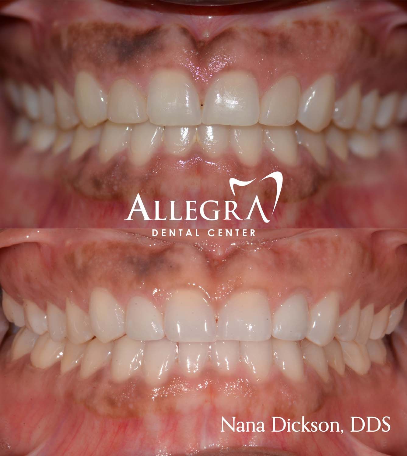 Veneers Before and After case 49 from Allegra Dental Center