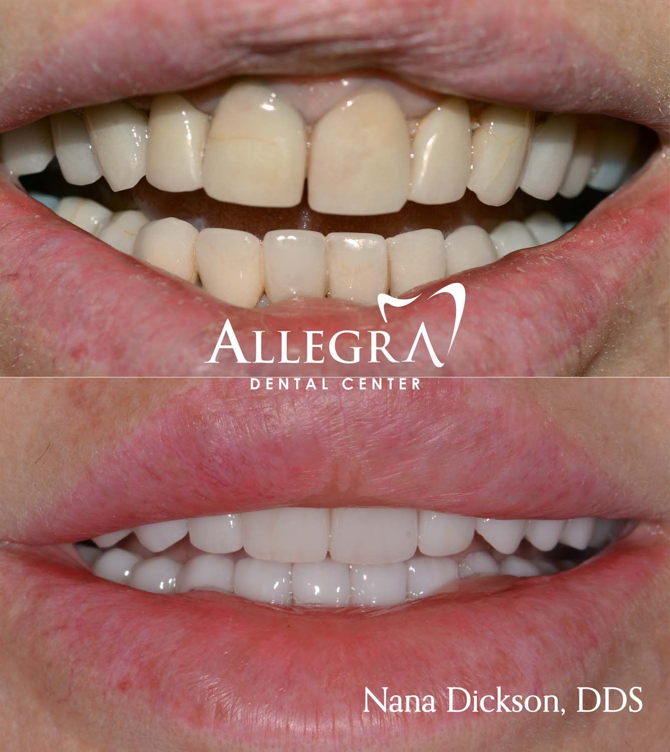 Veneers Before and After case 50 from Allegra Dental Center