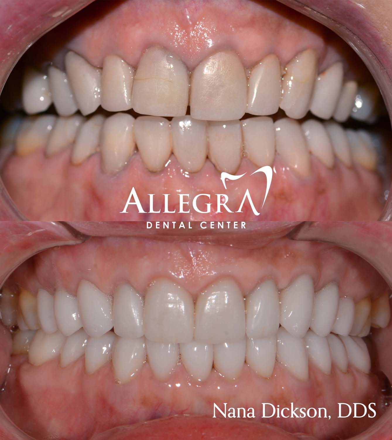 Veneers Before and After case 51 from Allegra Dental Center