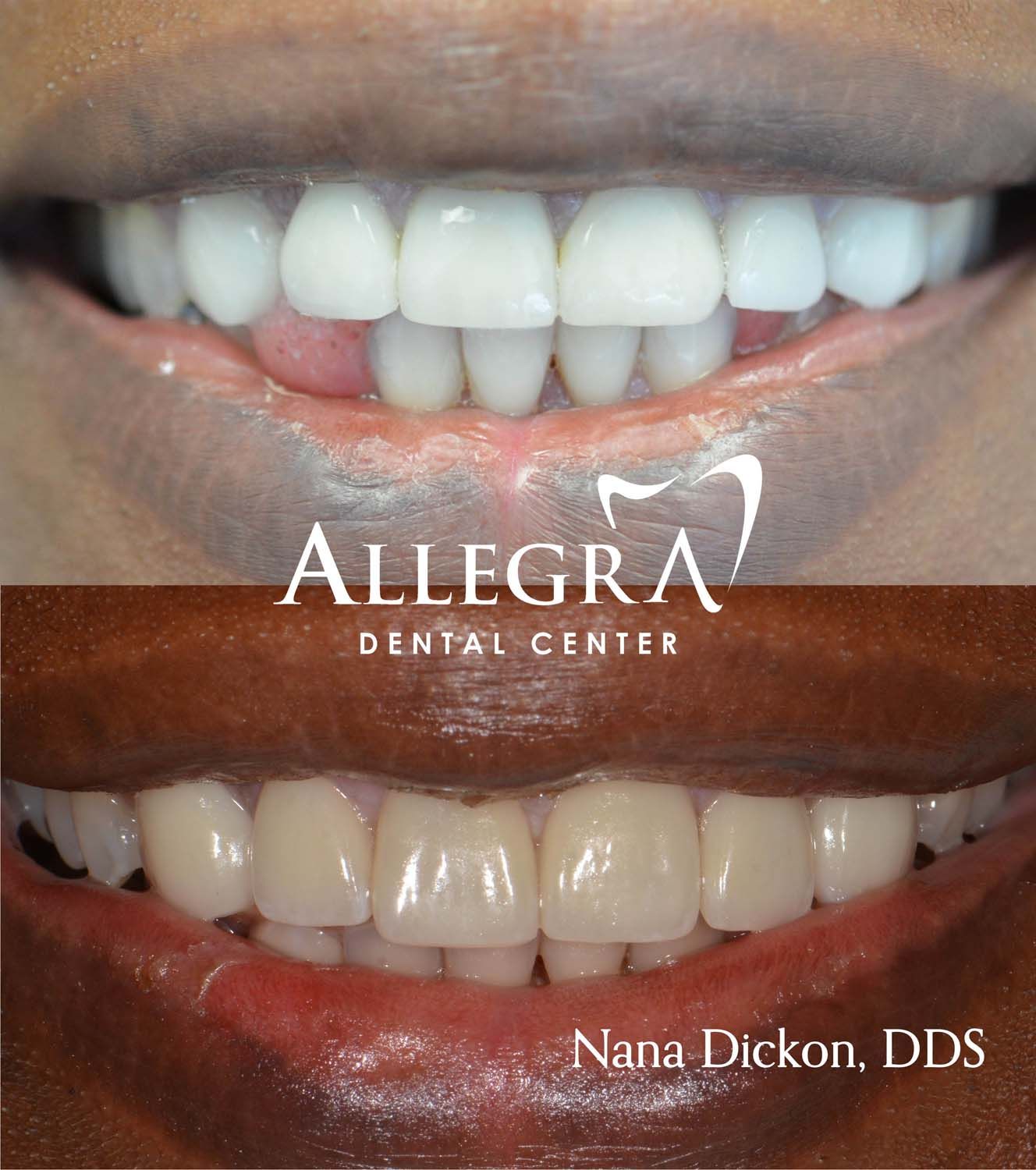 Veneers Before and After case 52 from Allegra Dental Center