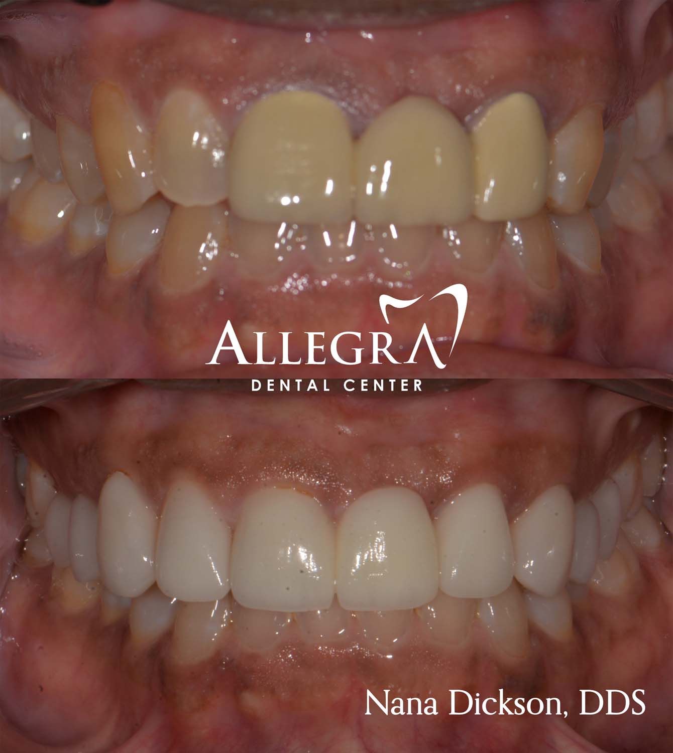 Veneers Before and After case 54 from Allegra Dental Center